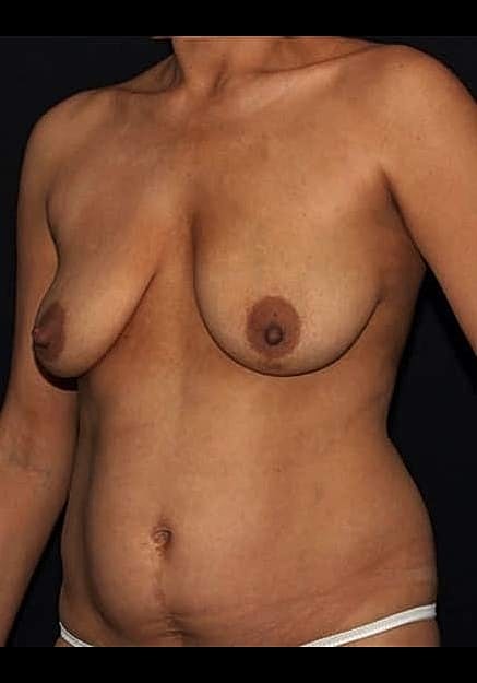 Breast Lift Before & After