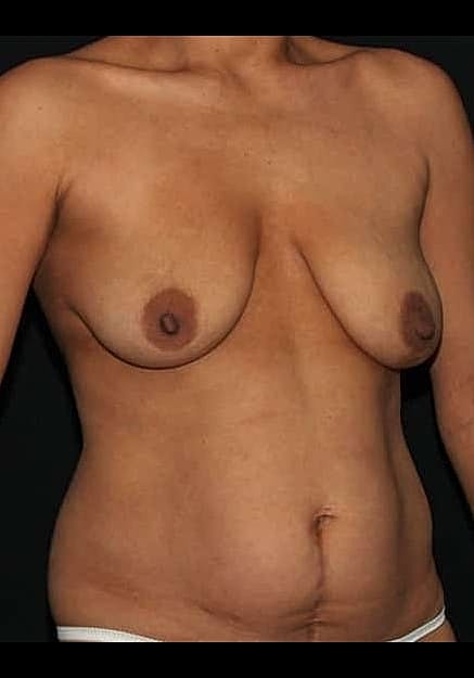Breast Lift Before & After