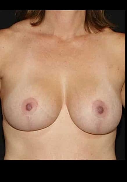 Breast Lift Before & After