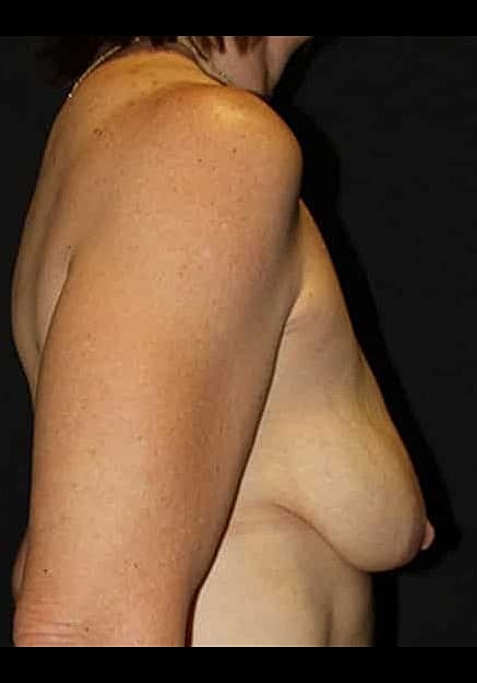 Breast Lift Before & After