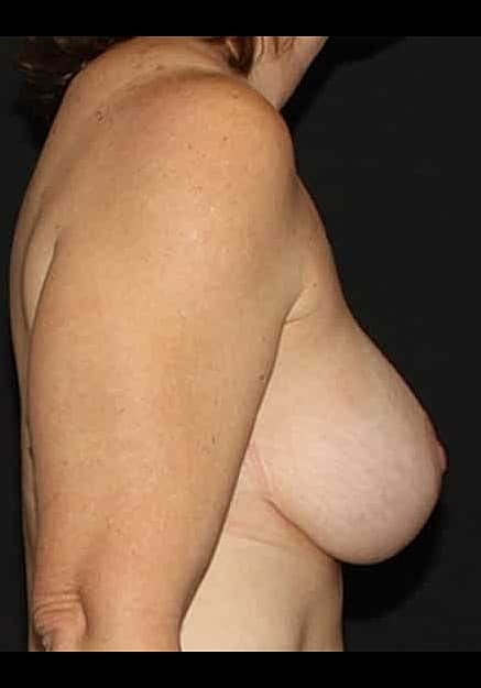Breast Lift Before & After