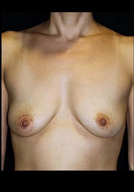 Breast Lift Before & After