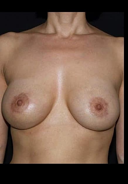 Breast Lift Before & After