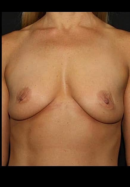 Breast Lift Before & After