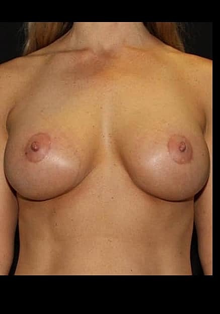 Breast Lift Before & After