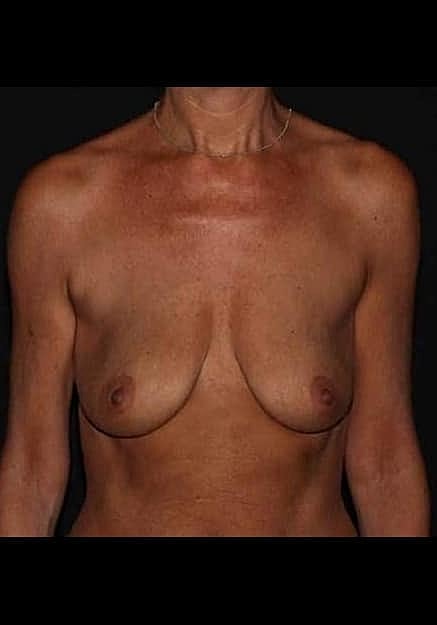 Breast Lift Before & After