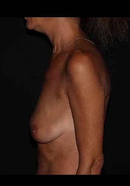 Breast Lift Before & After