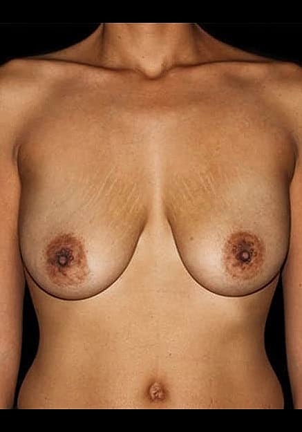 Breast Lift Before & After