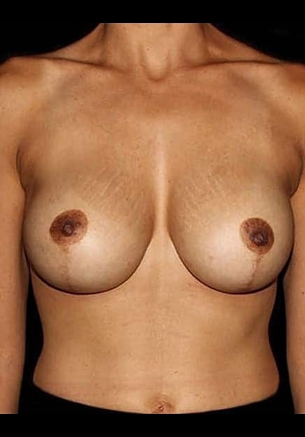 Breast Lift Before & After
