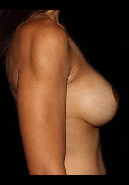 Breast Lift Before & After