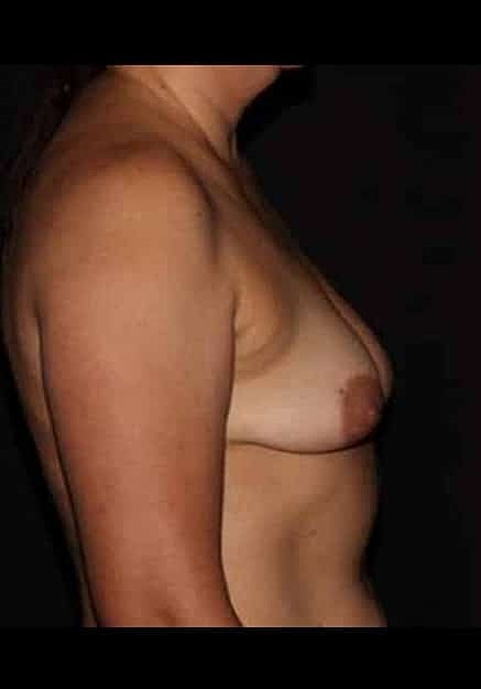Breast Lift Before & After