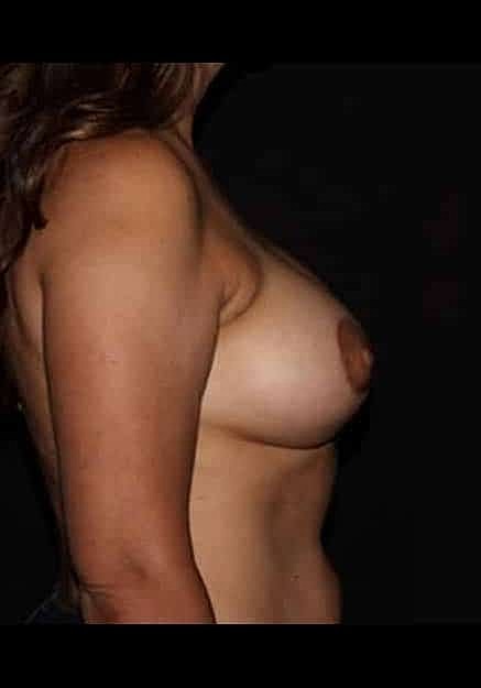 Breast Lift Before & After