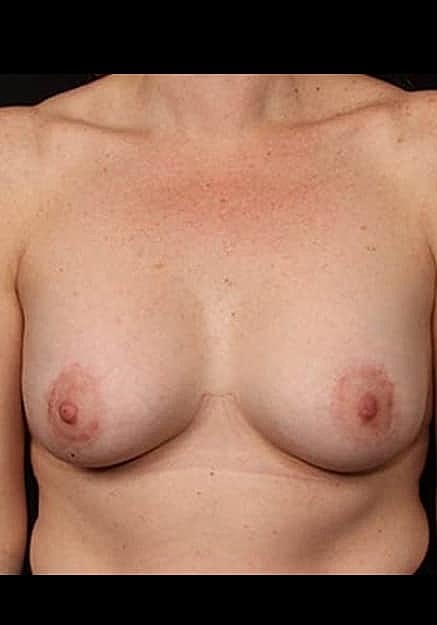 Breast Lift Before & After