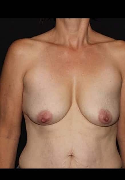 Breast Lift Before & After
