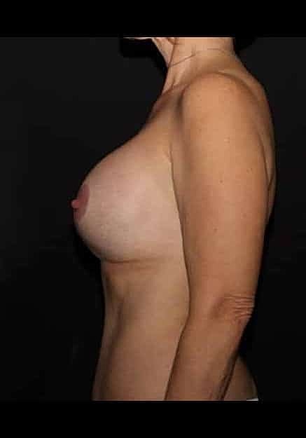 Breast Lift Before & After