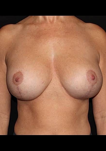 Breast Lift Before & After