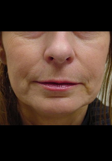 Restylane Before & After