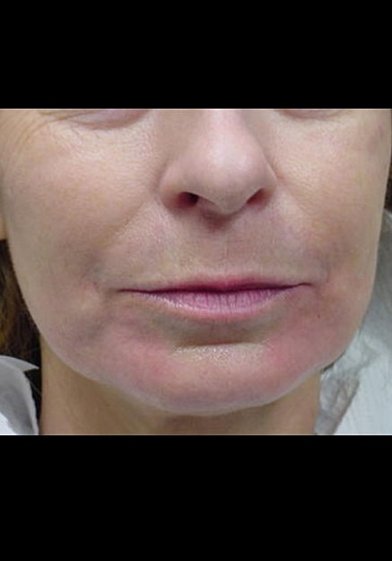 Restylane Before & After
