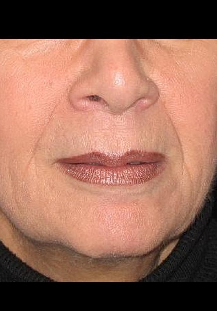 Restylane Before & After