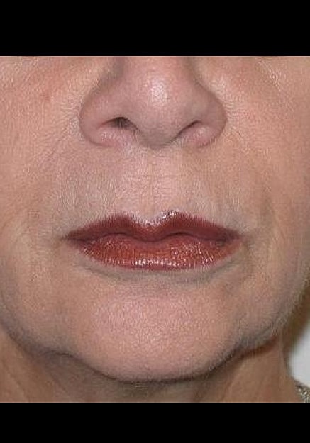 Restylane Before & After