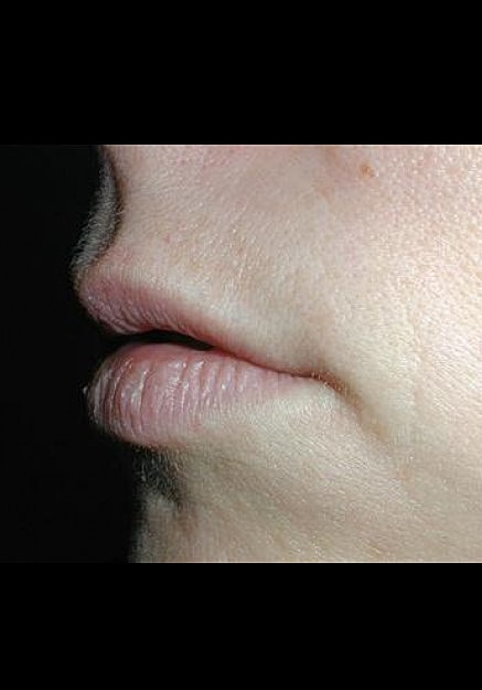 Restylane Before & After