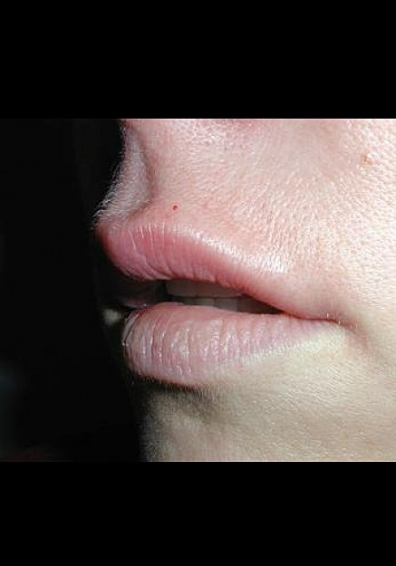 Restylane Before & After