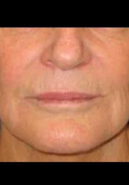 Restylane Before & After
