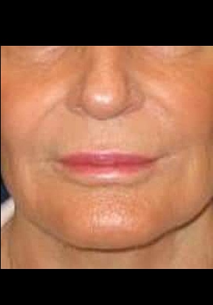 Restylane Before & After