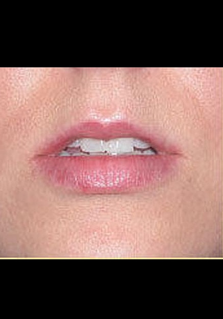 Restylane Before & After