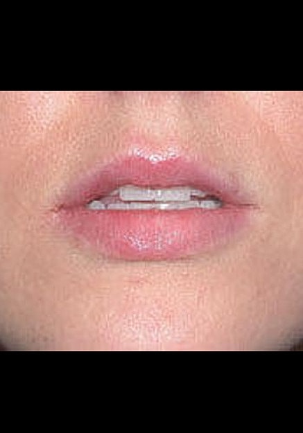 Restylane Before & After