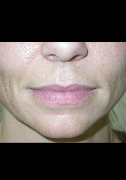 Restylane Before & After