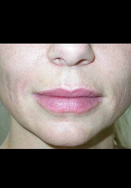 Restylane Before & After