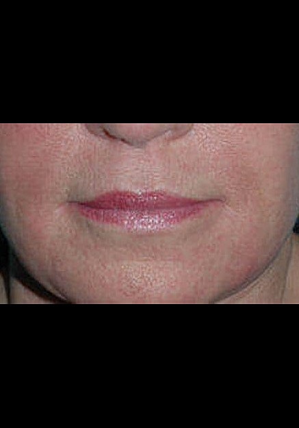 Restylane Before & After