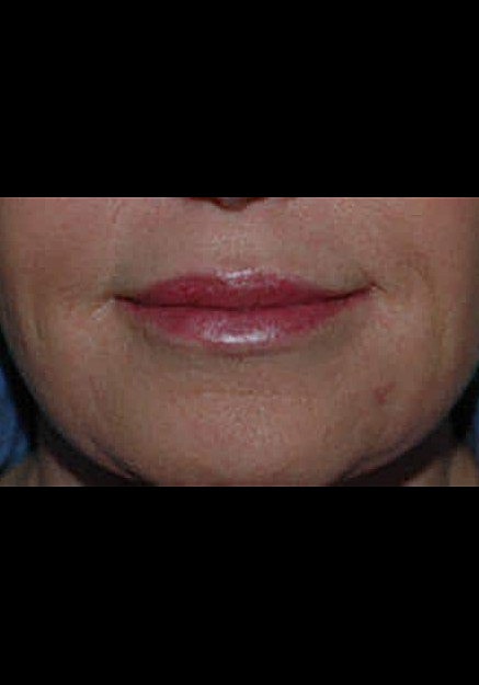 Restylane Before & After