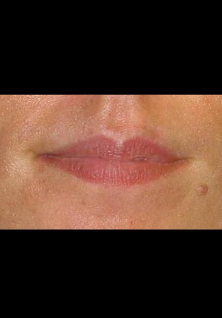 Restylane Before & After