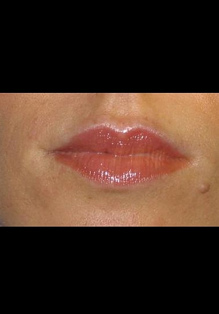 Restylane Before & After