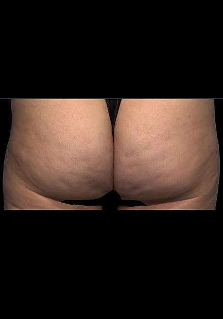 Qwo Cellulite Before & After
