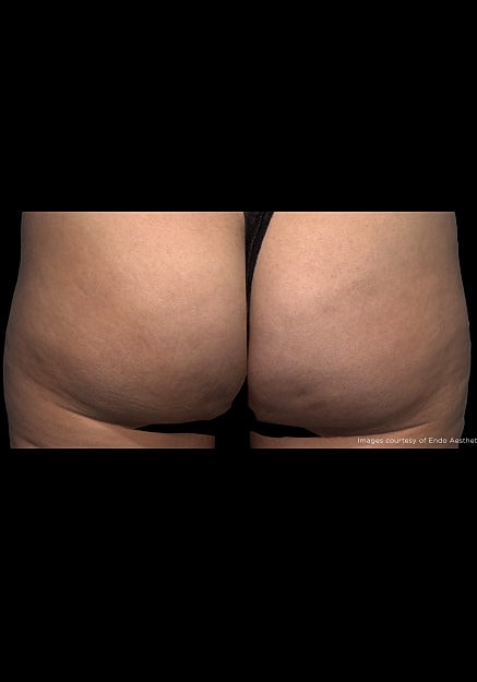 Qwo Cellulite Before & After