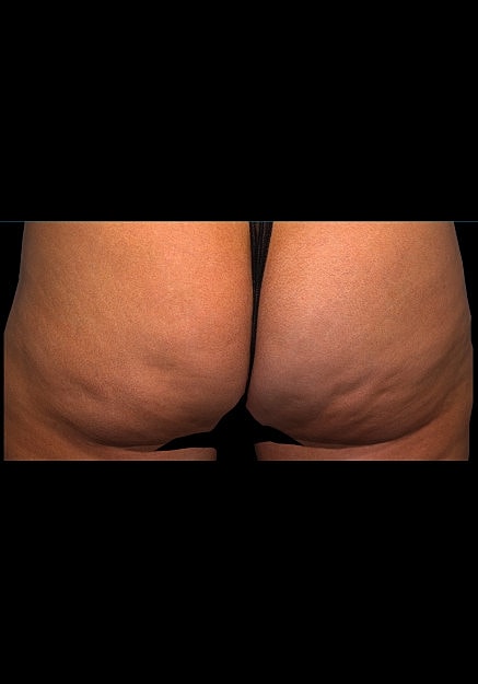 Qwo Cellulite Before & After