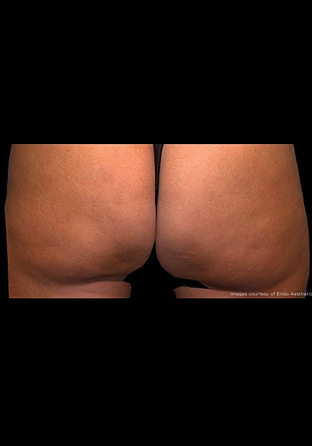 Qwo Cellulite Before & After