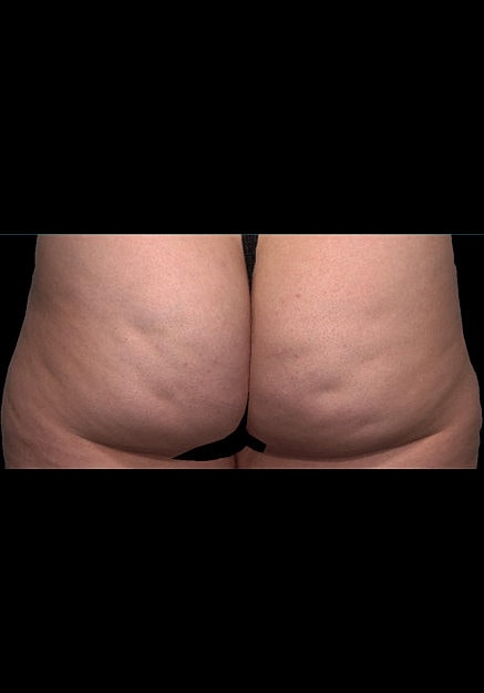 Qwo Cellulite Before & After