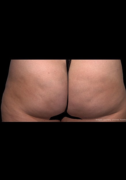 Qwo Cellulite Before & After