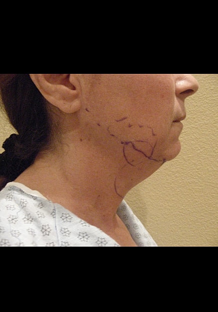 Chin Neck Liposuction Before & After