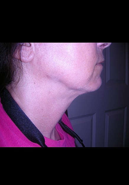 Chin Neck Liposuction Before & After