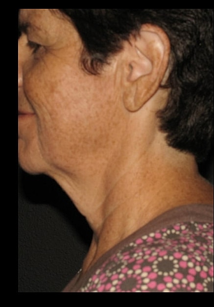 Chin Neck Liposuction Before & After