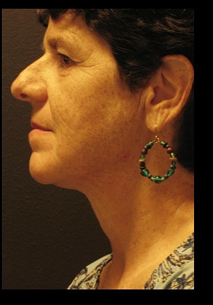 Chin Neck Liposuction Before & After