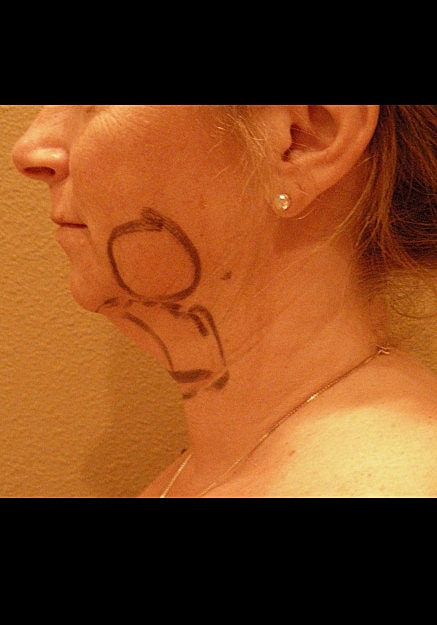 Chin Neck Liposuction Before & After