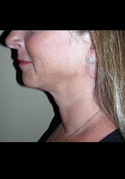 Chin Neck Liposuction Before & After