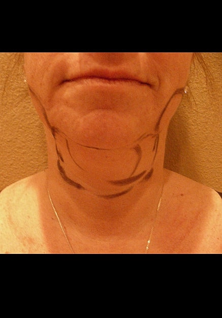 Chin Neck Liposuction Before & After