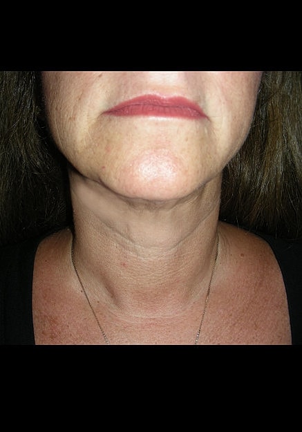 Chin Neck Liposuction Before & After